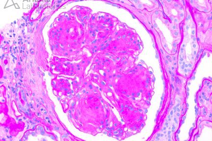 nodular glomerulosclerosis