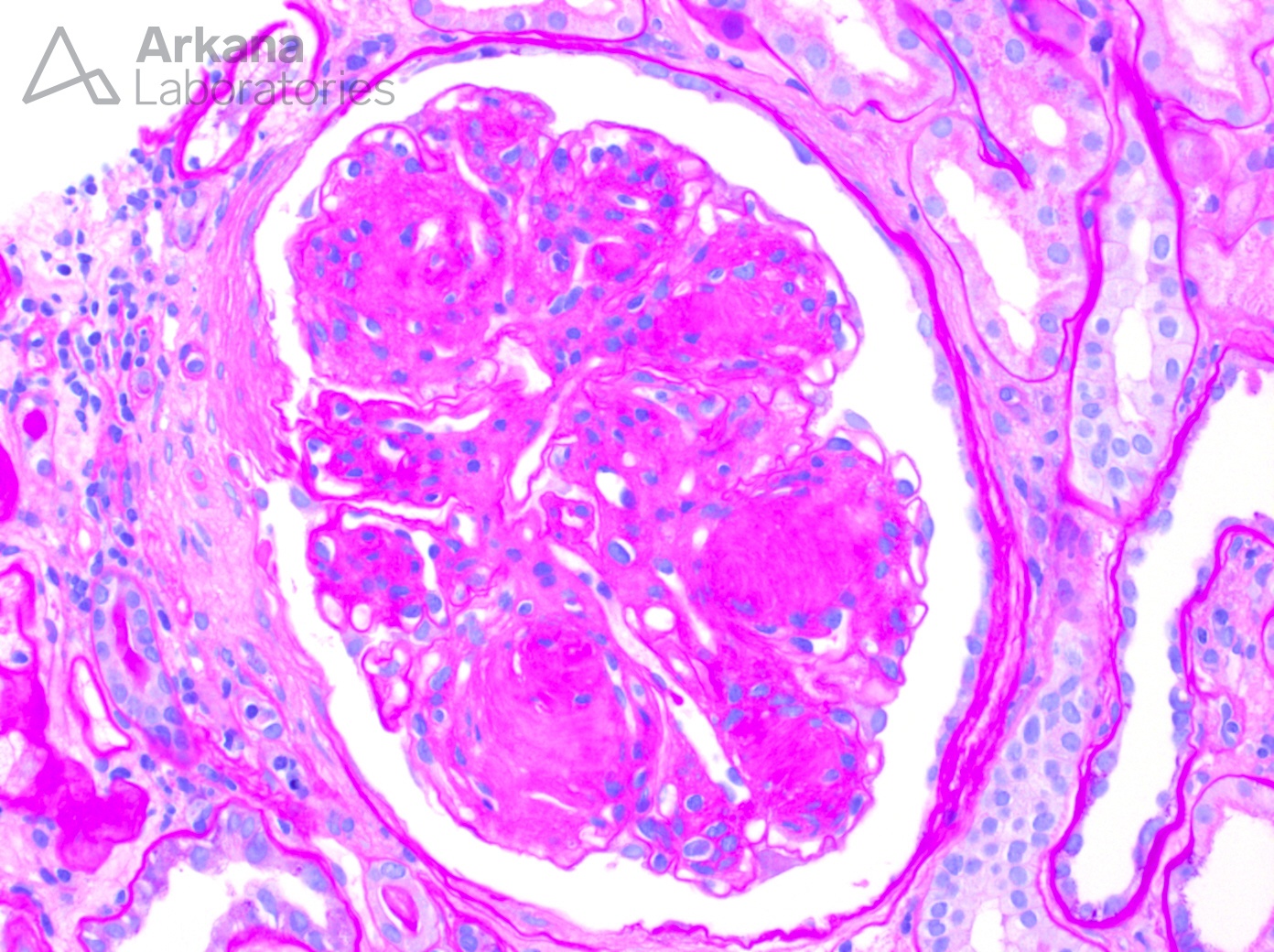 nodular glomerulosclerosis