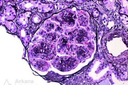 Monoclonal Gammopathy of Renal Significance