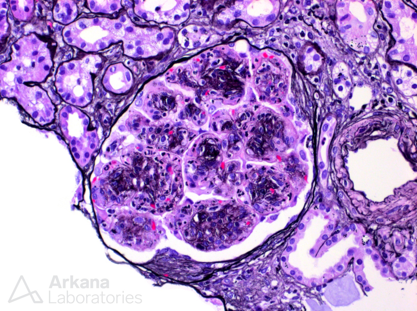 Monoclonal Gammopathy of Renal Significance