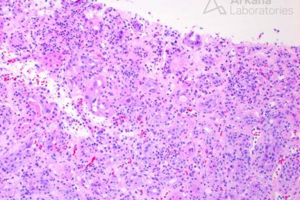 Acute Interstitial Nephritis