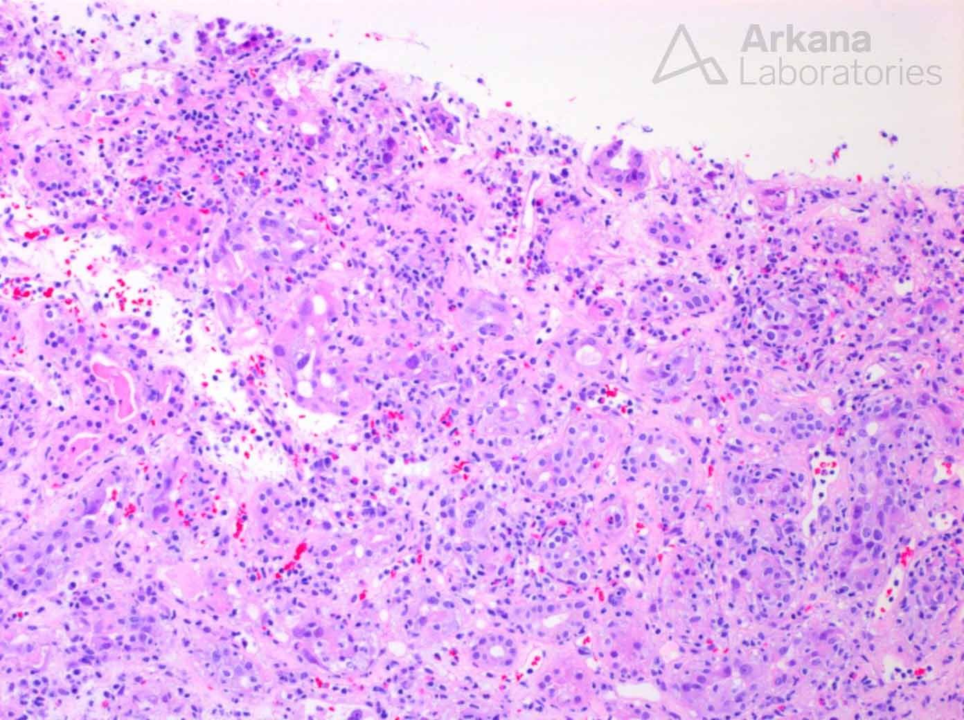 Acute Interstitial Nephritis