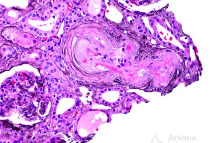 thrombotic microangiopathy, fibrin, arkana laboratories, renal pathology, nephropathology