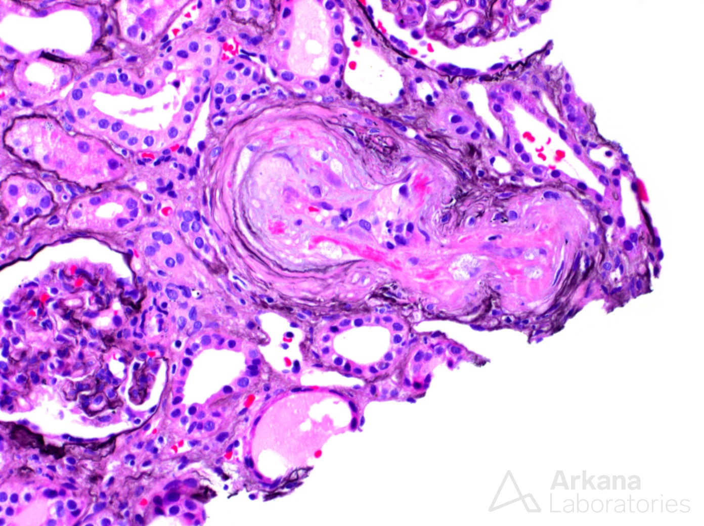 thrombotic microangiopathy, fibrin, arkana laboratories, renal pathology, nephropathology