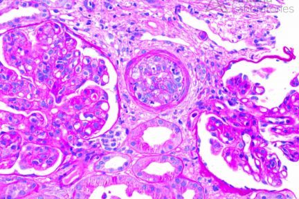 intimal arteritis as well as surrounding glomeruli with a membranoproliferative pattern of injury