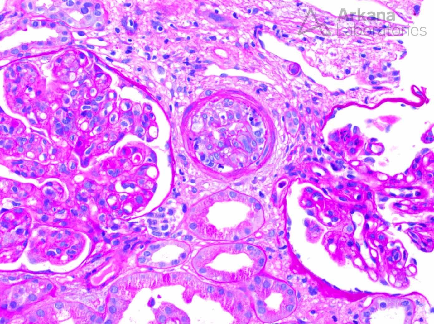 intimal arteritis as well as surrounding glomeruli with a membranoproliferative pattern of injury