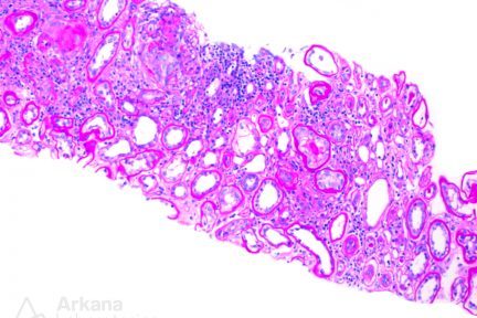 Kappa-Restricted Light Chain Deposition Disease, renal cortex