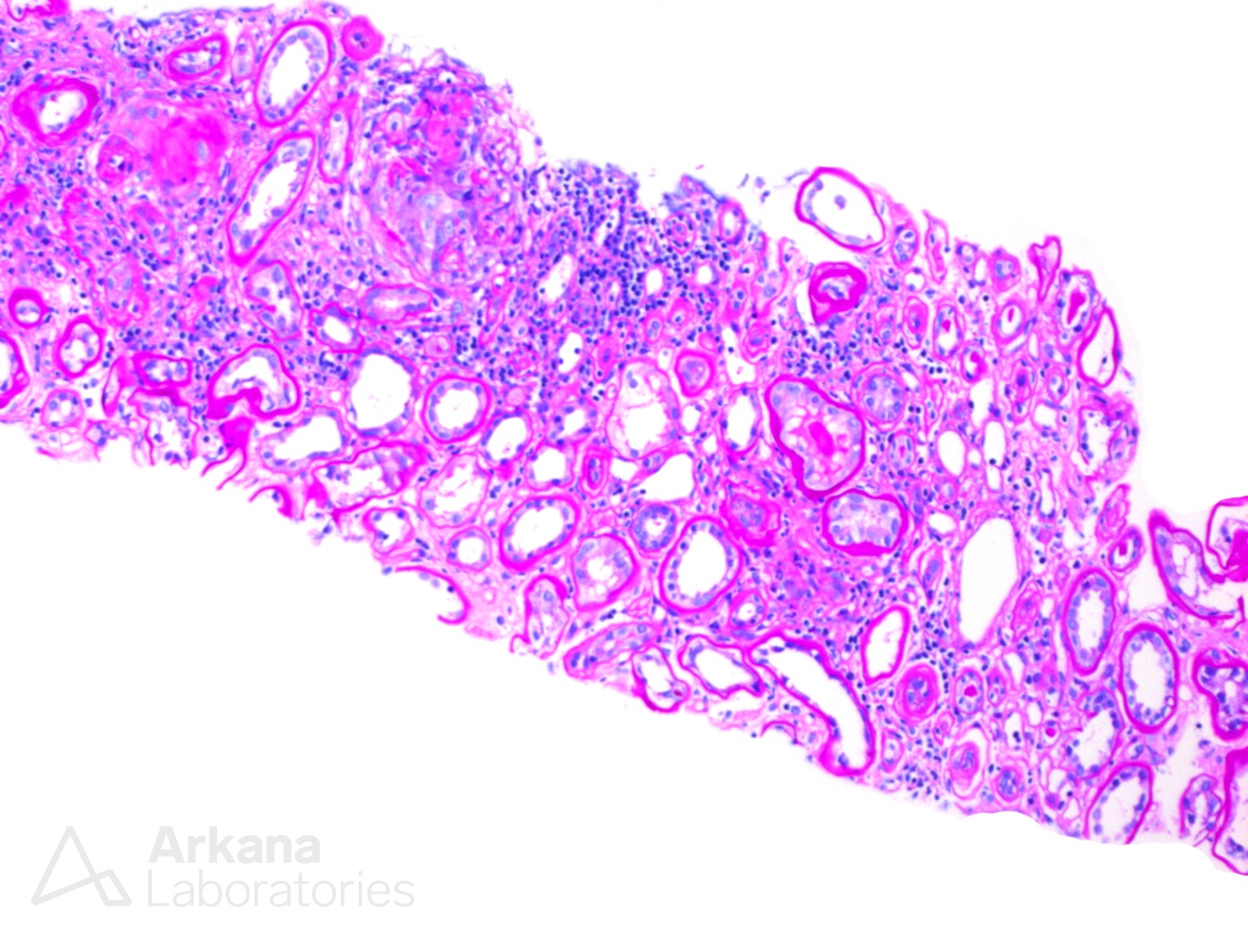 Kappa-Restricted Light Chain Deposition Disease, renal cortex