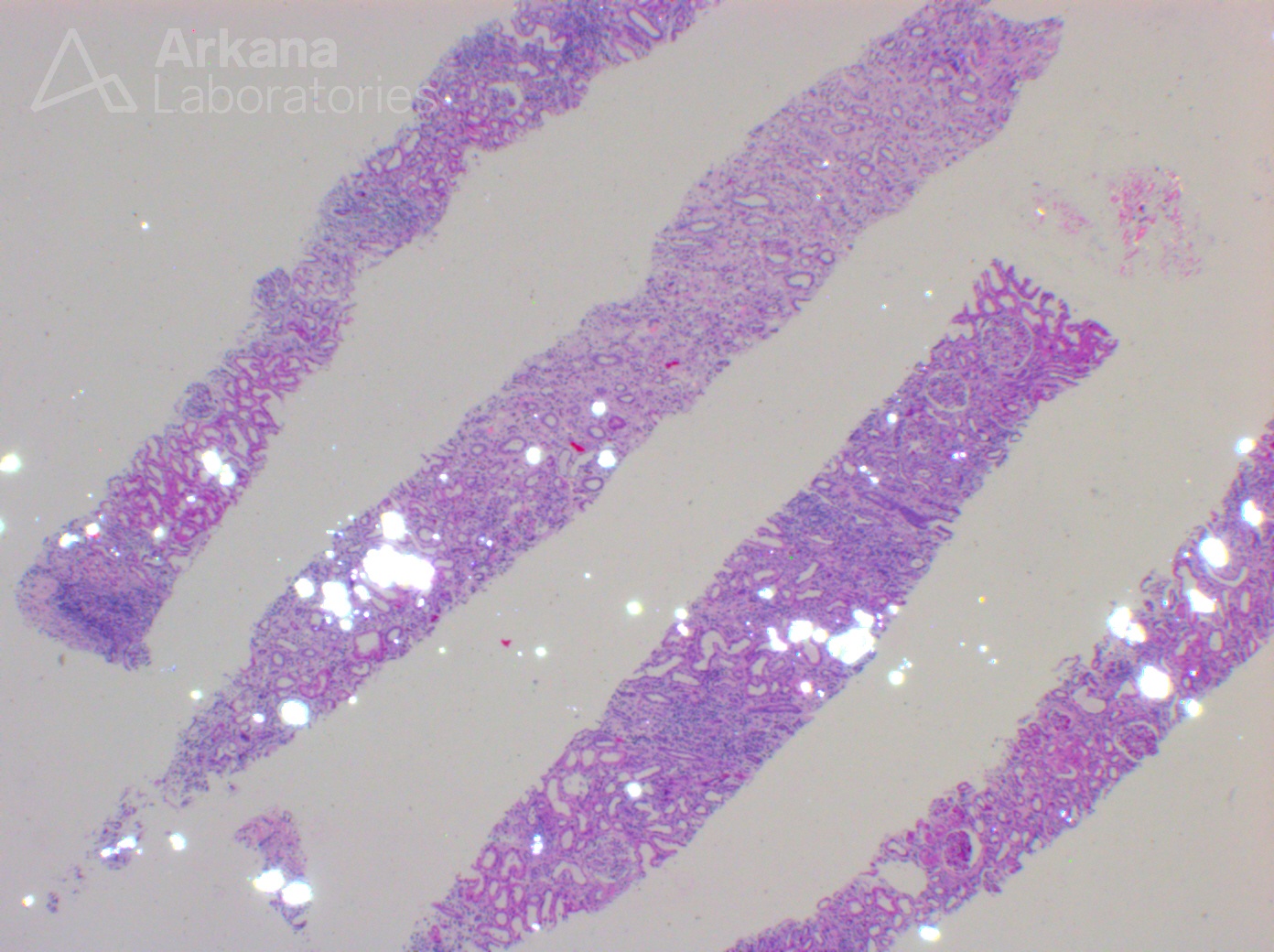 Renal Oxalosis, arkana laboratories, renal pathology, kidney biopsy, Diagnose This