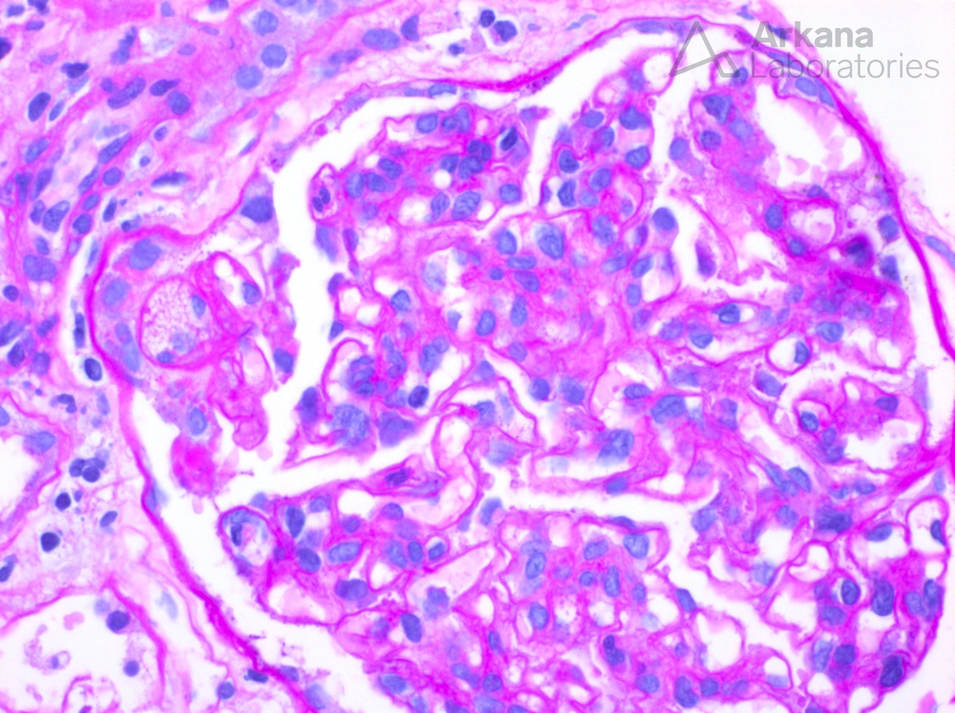 Nephrotic Syndrome, Arkana Laboratories, renal pathology, kidney injury