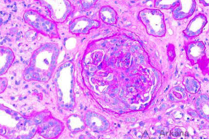 endocarditis-associated glomerulonephritis in renal biopsy at Arkana Laboratories
