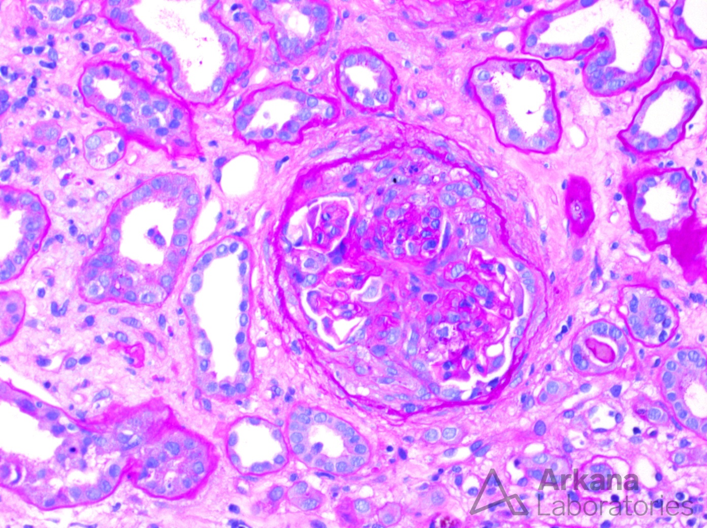 endocarditis-associated glomerulonephritis in renal biopsy at Arkana Laboratories