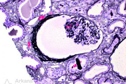 kidney ischemia in renal biopsy at Arkana Laboratories