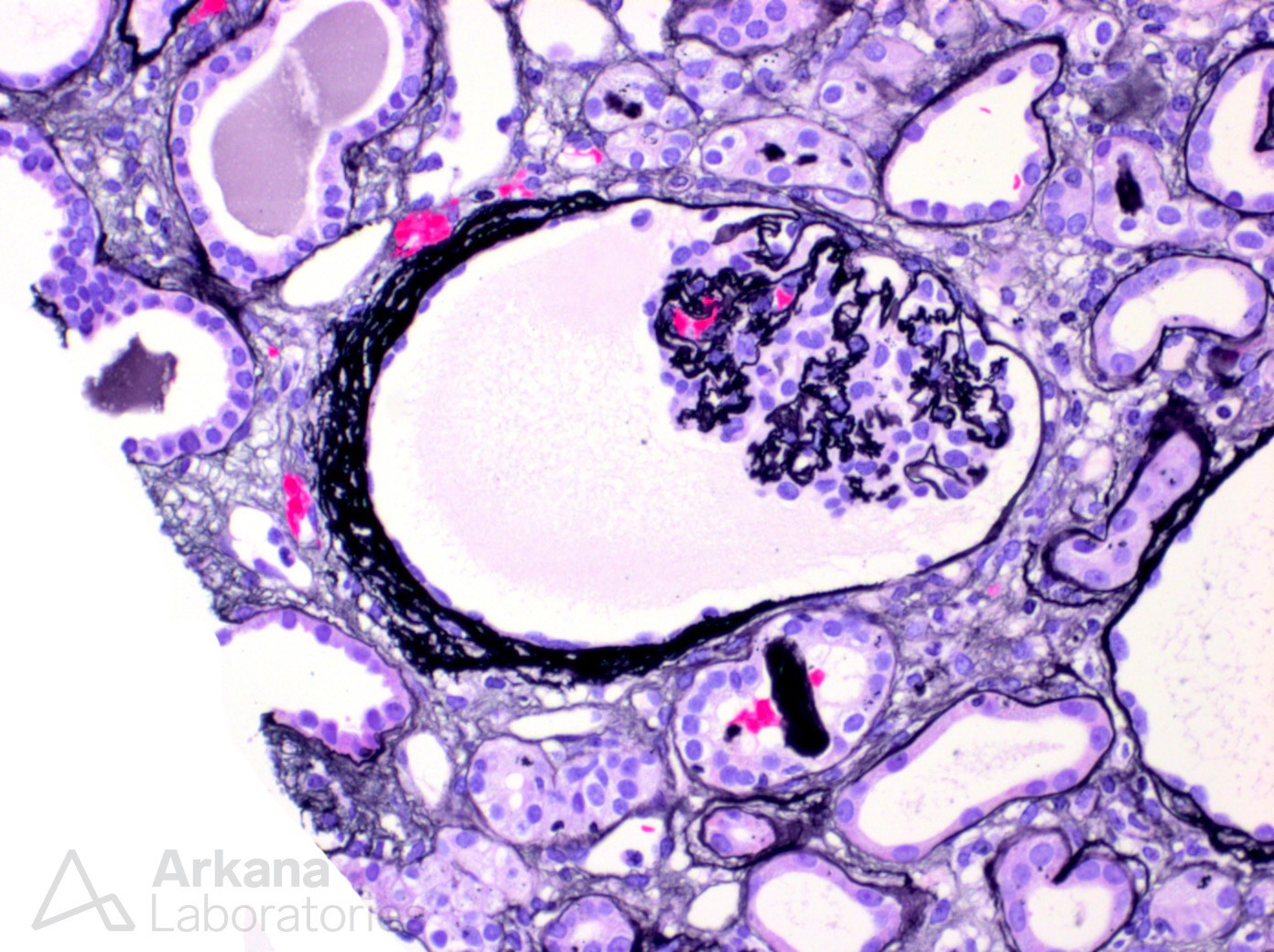 kidney ischemia in renal biopsy at Arkana Laboratories