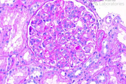 Sjögren Syndrome, Diagnose This, Arkana Laboratories, renal pathology