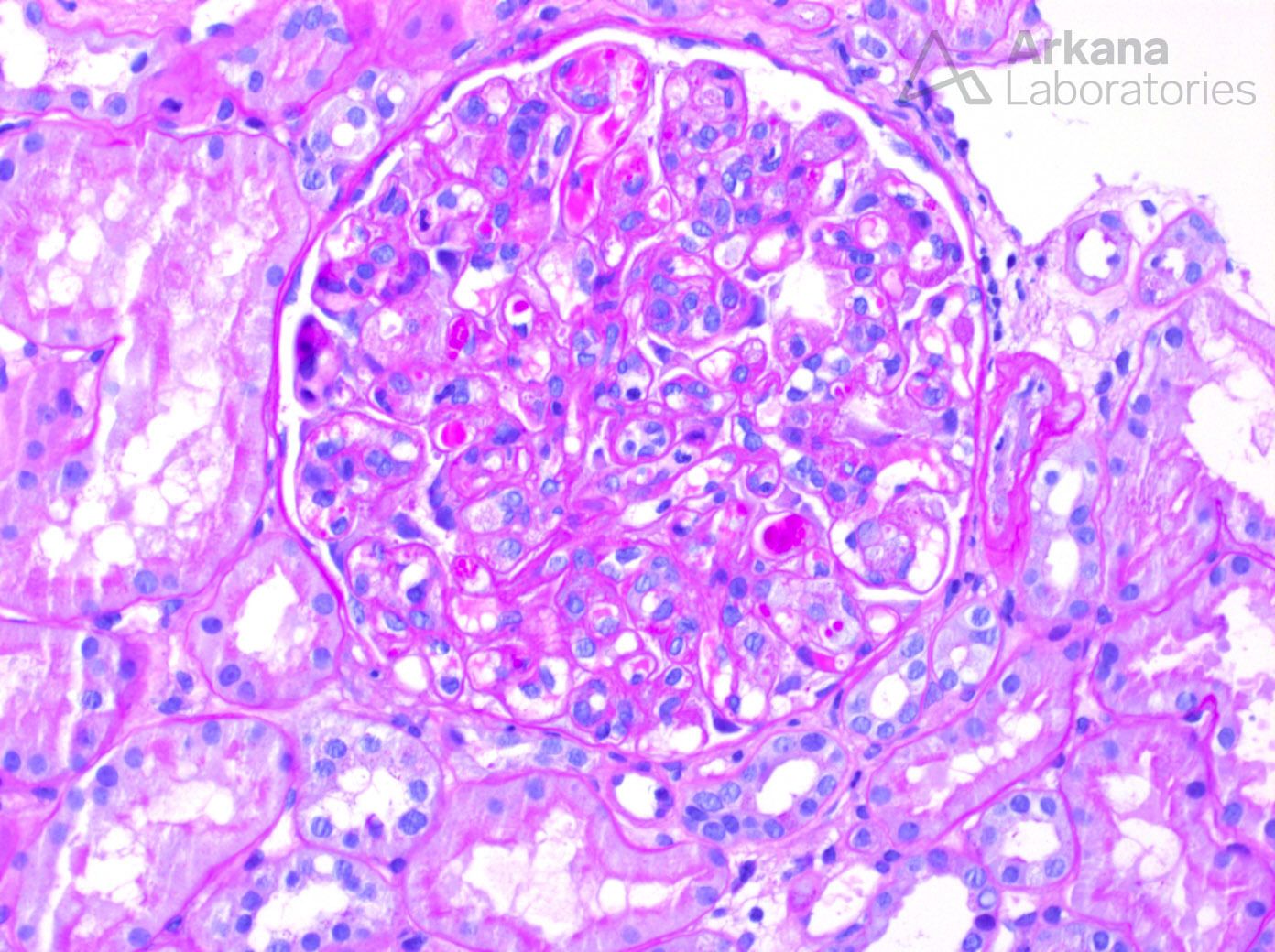 Sjögren Syndrome, Diagnose This, Arkana Laboratories, renal pathology