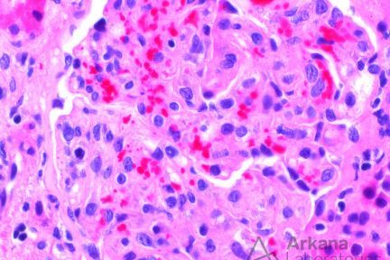 Thrombotic Microangiopathy