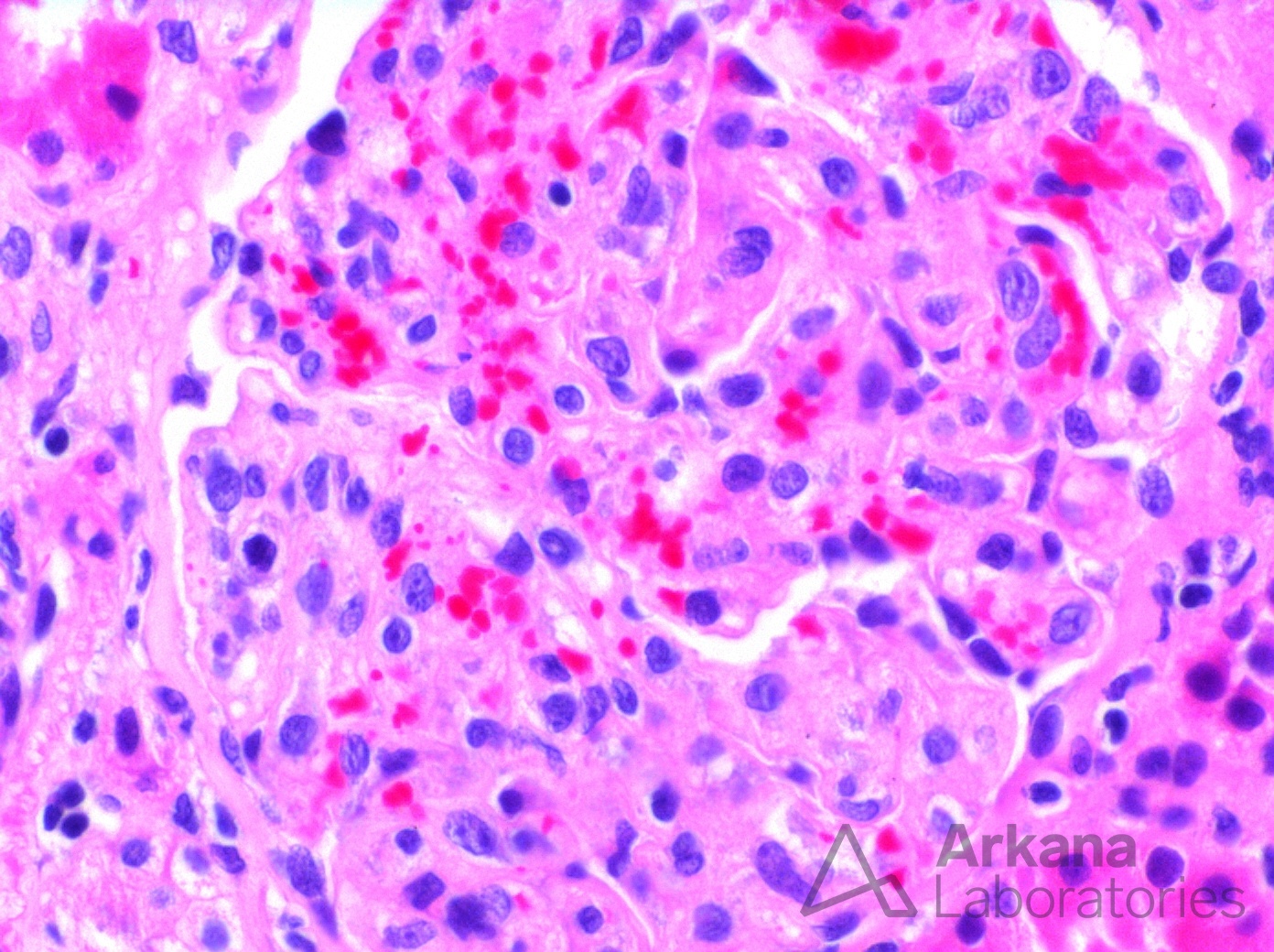 Thrombotic Microangiopathy