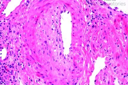 Transplant Arteriopathy, active antibody-mediated rejection