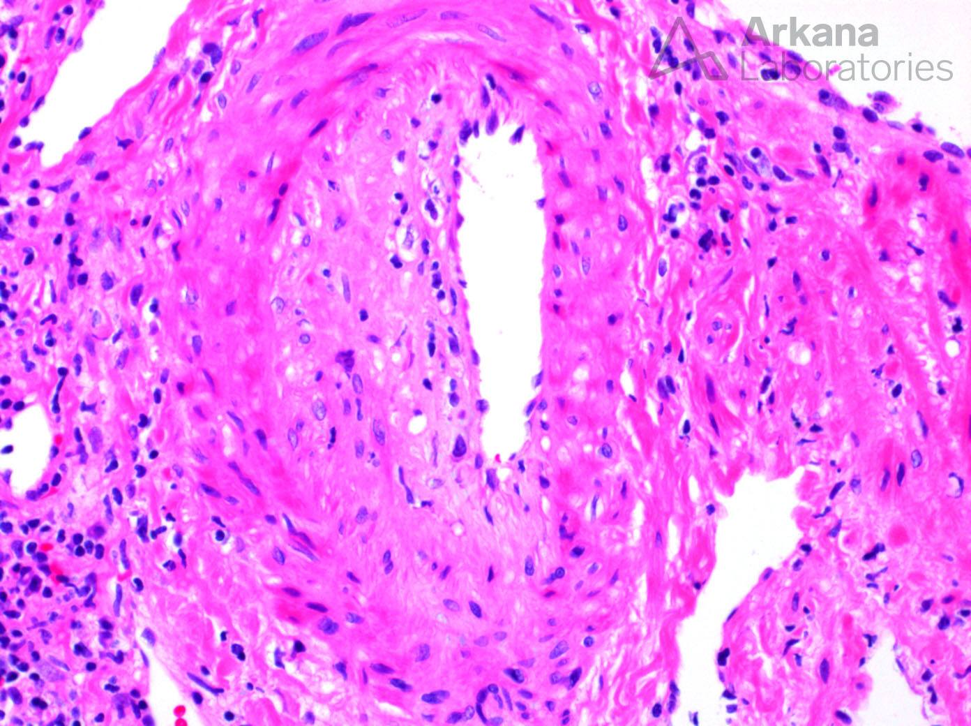 Transplant Arteriopathy, active antibody-mediated rejection