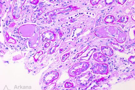 PAS negative intratubular casts in renal biopsy at Arkana Laboratories