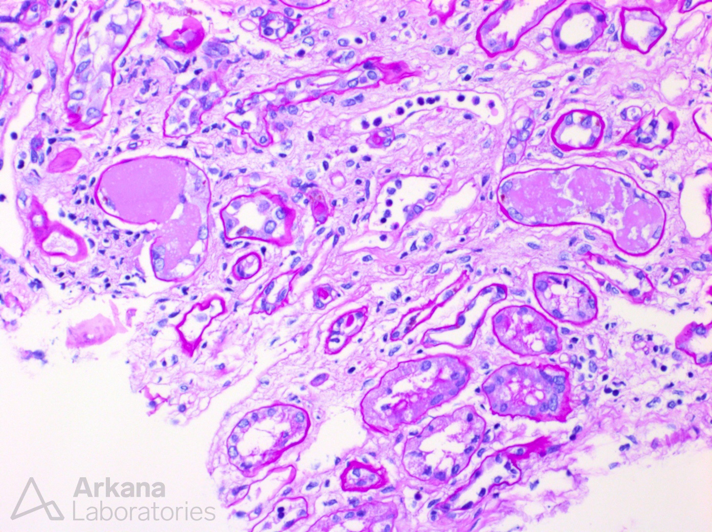 PAS negative intratubular casts in renal biopsy at Arkana Laboratories