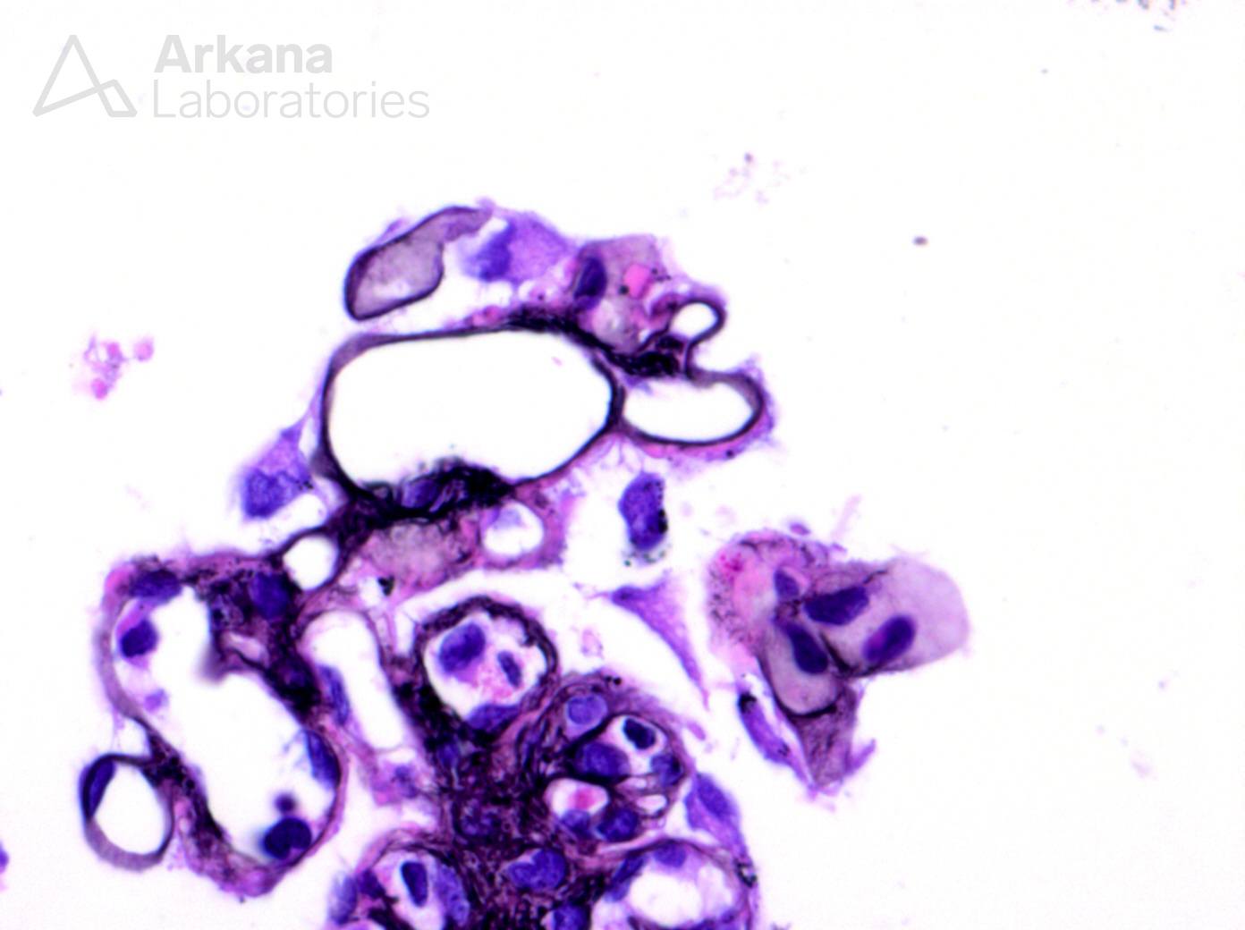 Membranous-Like glomerulopathy with Masked IgG Kappa Deposits, membranous pattern glomerulopathy with C3 staining by immunofluorescence