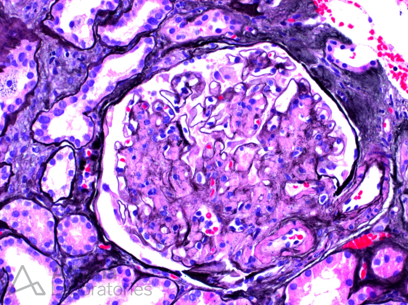 absent silver impregnation in the mesangial matrix