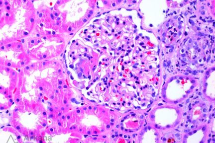 ANCA-Mediated Vasculitis