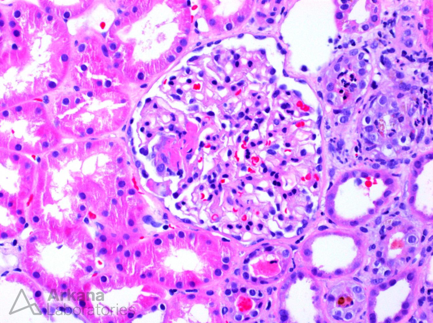 ANCA-Mediated Vasculitis