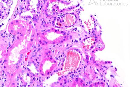 Rhabdomyolysis in kidney biopsy at Arkana Laboratories