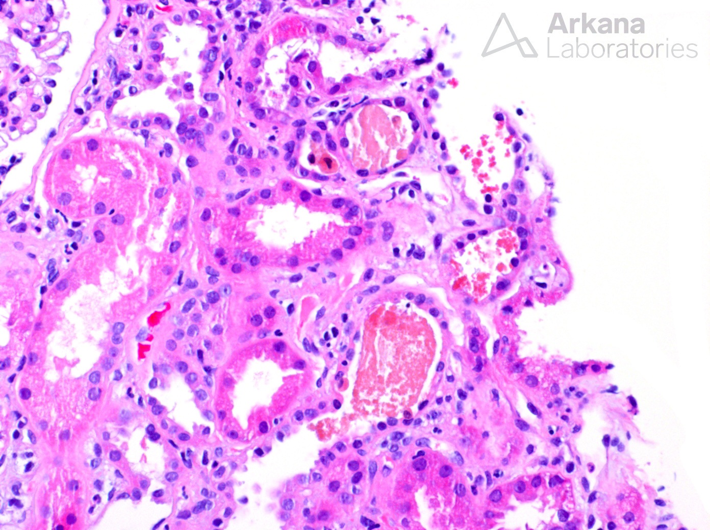 Rhabdomyolysis in kidney biopsy at Arkana Laboratories