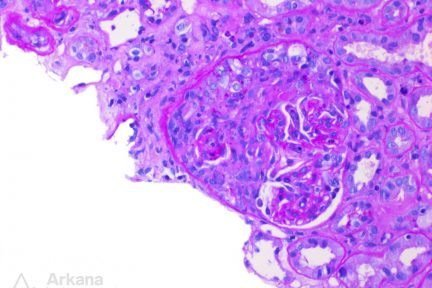 ANCA-mediated glomerulonephritis, arkana laboratories, renal pathology, kidney biopsy