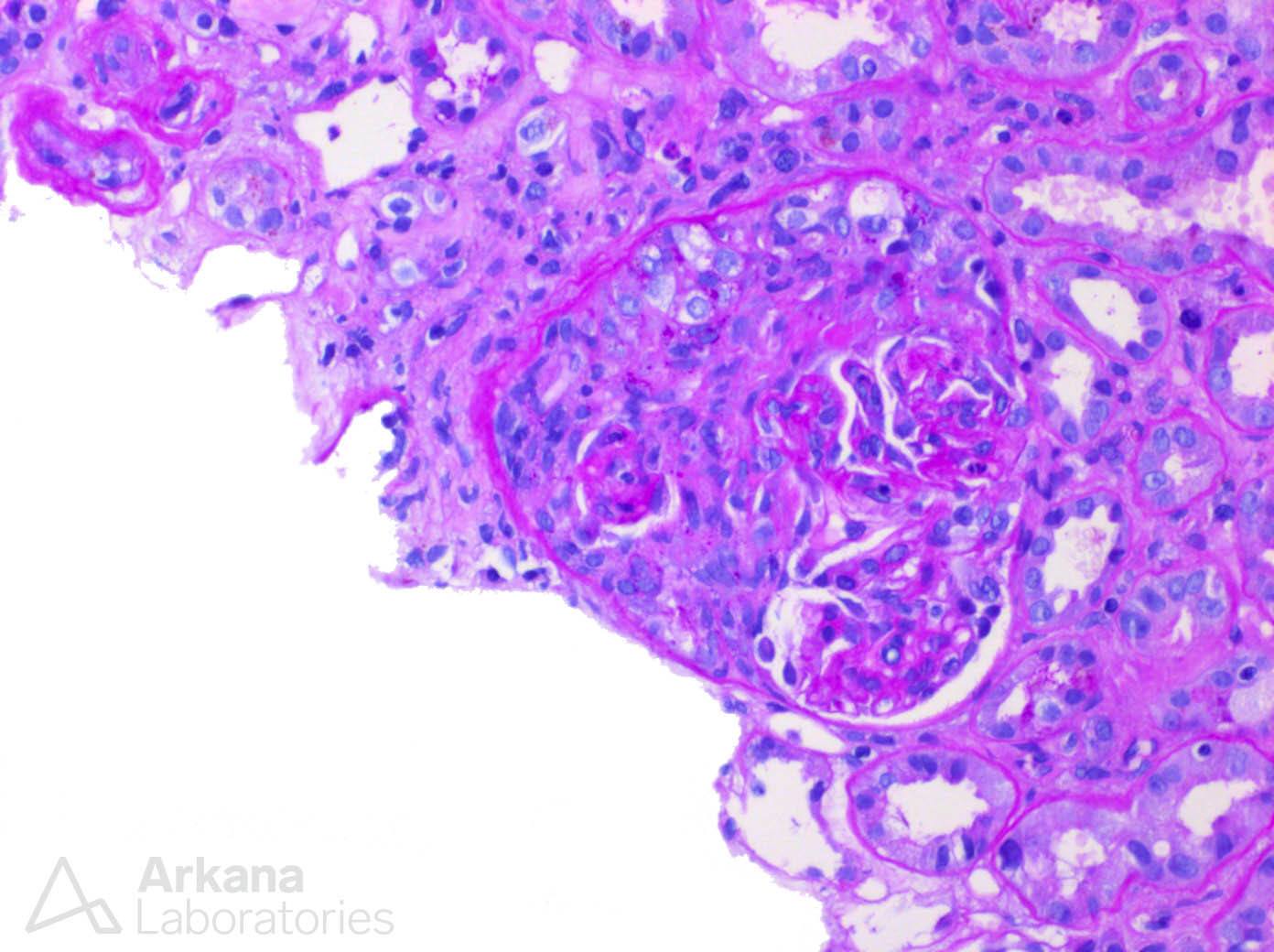 ANCA-mediated glomerulonephritis, arkana laboratories, renal pathology, kidney biopsy